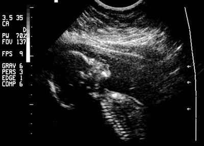 Развитие человеческого зародыша - УЗИ